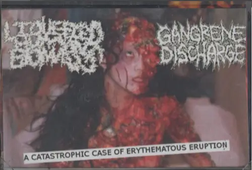 Gangrene Discharge : A Catastrophic Case of Erythematous Eruption